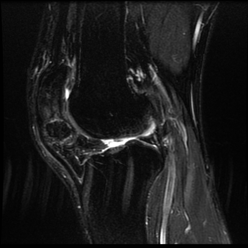 Figure 4 for case Parosteal osteoma ( RID4002 )